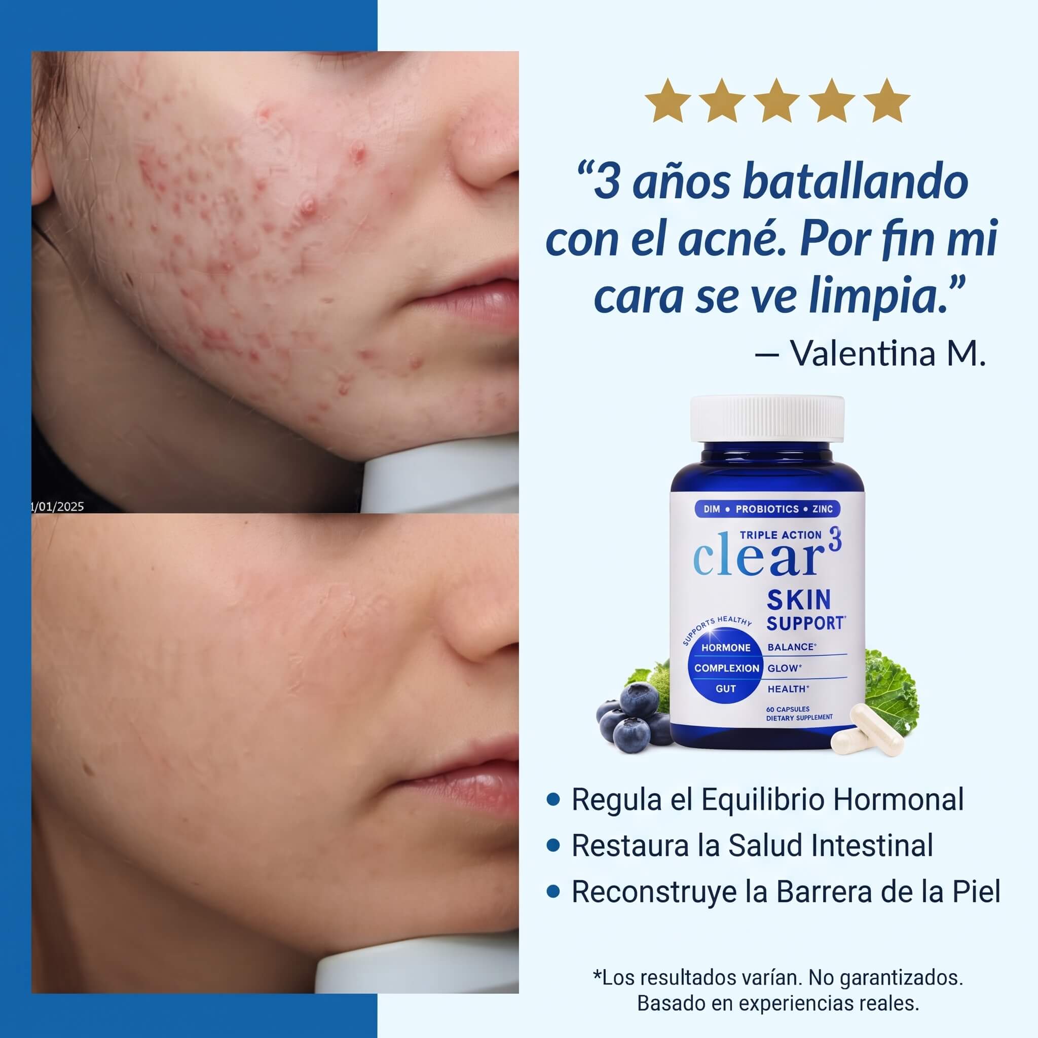 Suplemento Anti-Acné Hormonal — Clear Skin 3